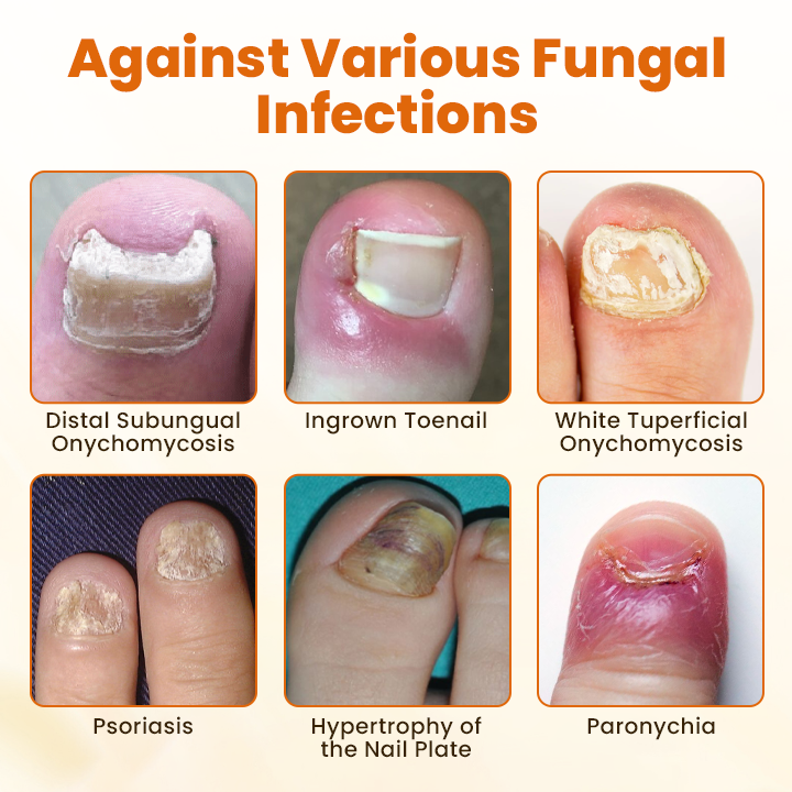 Timilk® FungiBee Advanced Nail Repair Spray