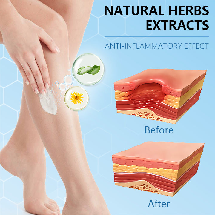 Ceoerty™ Varicose Veins Cream with Hydrogel(A)