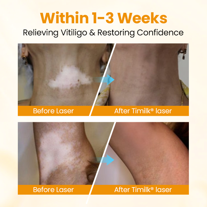 Timilk® VitiGone Rapid Spray — 2–3 Week Repigmentation with OTDS