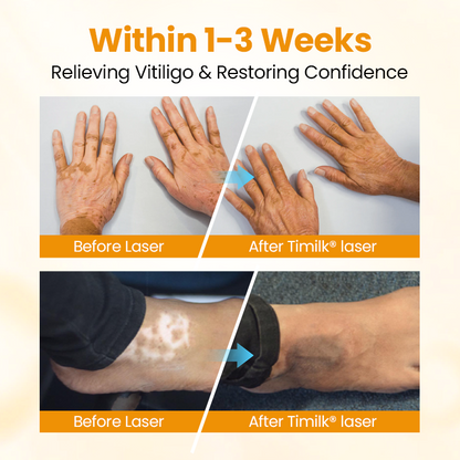 Timilk® VitiGone Rapid Spray — 2–3 Week Repigmentation with OTDS