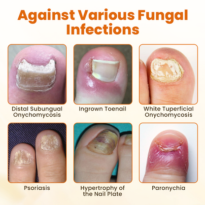 Timilk® FungiBee Advanced Nail Repair Spray