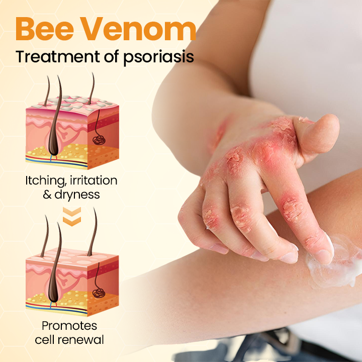 Timilk® BeeLieve Psoriasis Skin Care