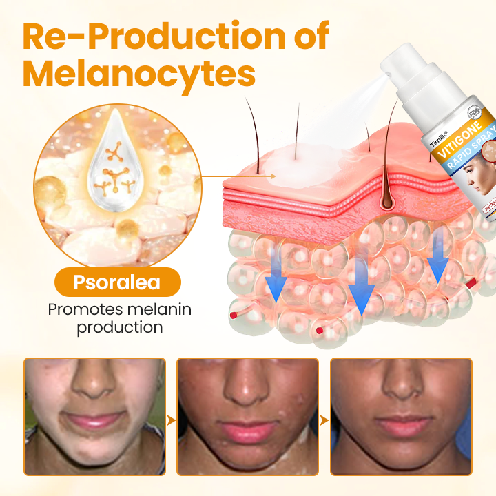 Timilk® VitiGone Rapid Spray — 2–3 Week Repigmentation with OTDS