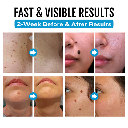 Bikenda® SpotlessDerm Mole and Wart Laser Pen-A