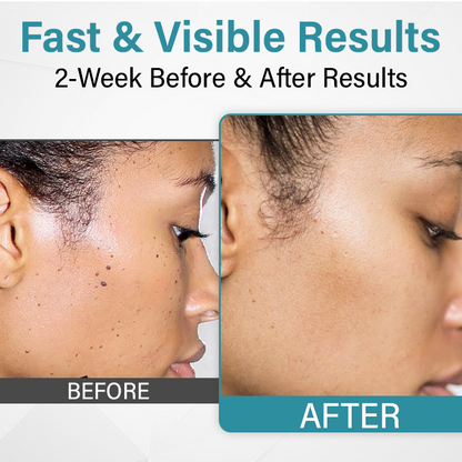 Bikenda® SpotAway Painless Laser Mole Removal Pen