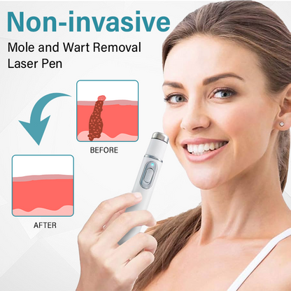 Bikenda® SpotAway Painless Laser Mole Removal Pen