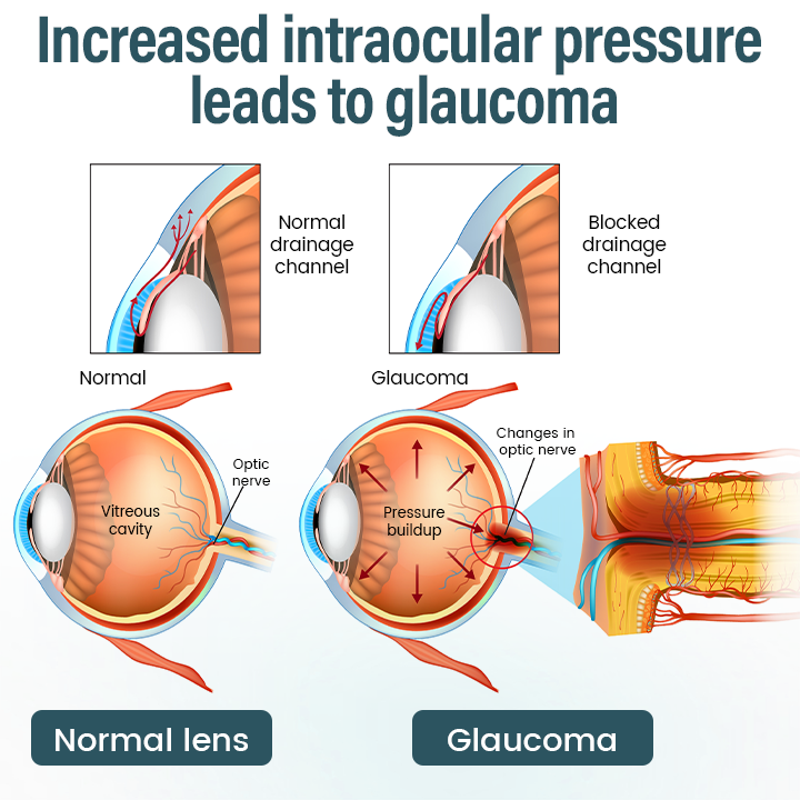 Timilk® OptiFusion Nano Eye Drops Serum (A)