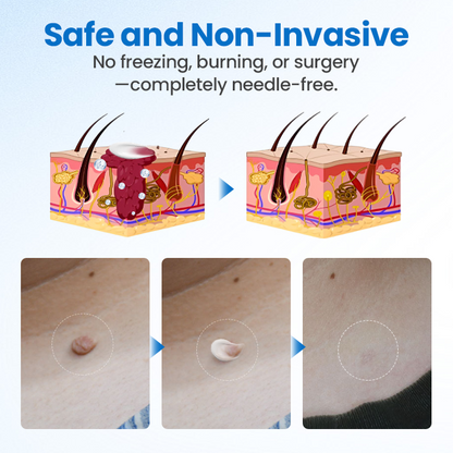 Timilk® TagGone Wart Removal Cream (A)