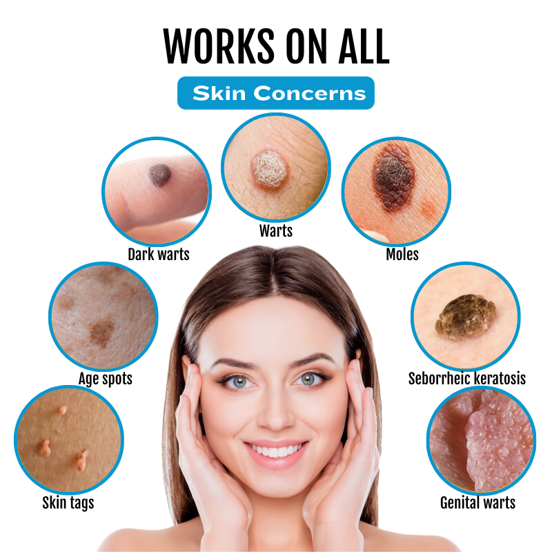 Bikenda® SpotlessDerm Mole and Wart Laser Pen-A